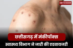 Monkey Pox in Chhattisgarh